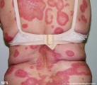 psoriasis-pustular psoriasis