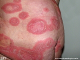 psoriasis-pustular psoriasis