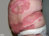 psoriasis-pustular psoriasis