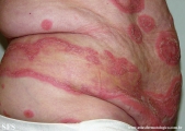 psoriasis-pustular psoriasis