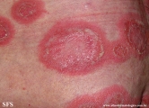 psoriasis-pustular psoriasis