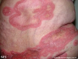 psoriasis-pustular psoriasis