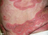 psoriasis-pustular psoriasis