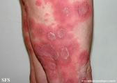 psoriasis-pustular psoriasis