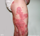 psoriasis-pustular psoriasis