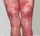 psoriasis-pustular psoriasis