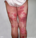 psoriasis-pustular psoriasis