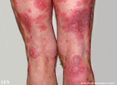 psoriasis-pustular psoriasis