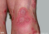 psoriasis-pustular psoriasis