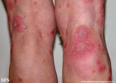 psoriasis-pustular psoriasis