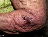 squamous cell carcinoma