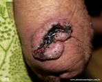squamous cell carcinoma