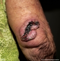 squamous cell carcinoma