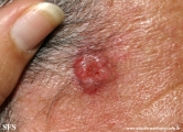 squamous cell carcinoma