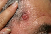 squamous cell carcinoma