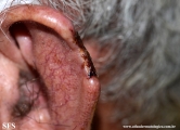 squamous cell carcinoma