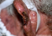 squamous cell carcinoma