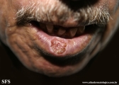 squamous cell carcinoma