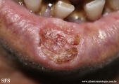 squamous cell carcinoma