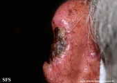 squamous cell carcinoma