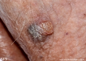 squamous cell carcinoma