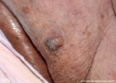 squamous cell carcinoma