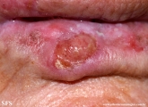 squamous cell carcinoma