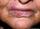 squamous cell carcinoma