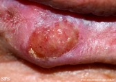 squamous cell carcinoma