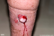 squamous cell carcinoma