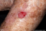 squamous cell carcinoma