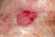 squamous cell carcinoma