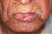 squamous cell carcinoma