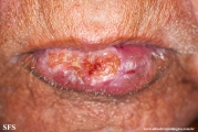 squamous cell carcinoma