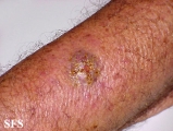 squamous cell carcinoma