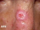 squamous cell carcinoma