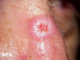squamous cell carcinoma
