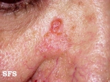 squamous cell carcinoma