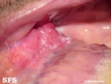 squamous cell carcinoma