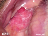 squamous cell carcinoma