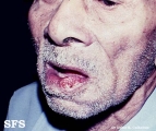 squamous cell carcinoma