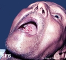 squamous cell carcinoma