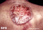 squamous cell carcinoma
