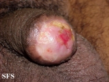 squamous cell carcinoma
