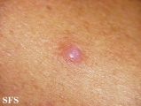 squamous cell carcinoma