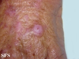 squamous cell carcinoma