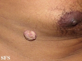 squamous cell carcinoma