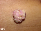 squamous cell carcinoma