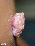 squamous cell carcinoma