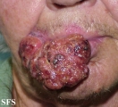 squamous cell carcinoma